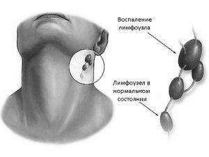 лімфовузлів