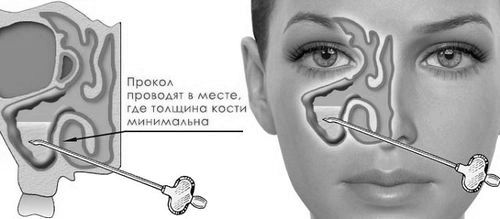 Очищення гайморових пазух від гною хронічний гайморит без гною