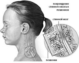 як лікувати остеохондроз в шиї