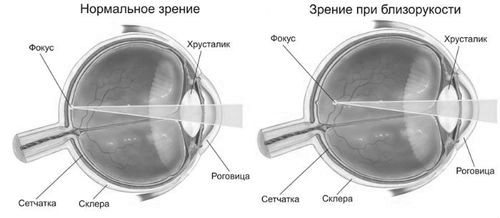 Причини короткозорості одного і обох очей короткозорості