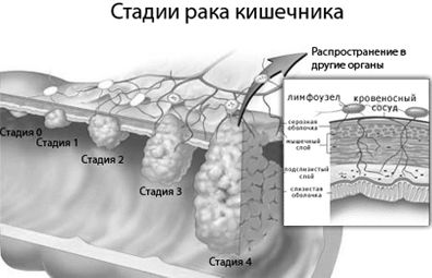 рак дванадцятипалої кишки