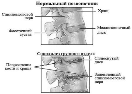 спондильоз