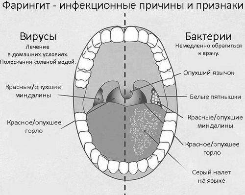 фарингіт