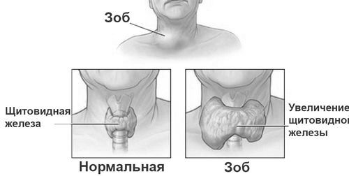 Вузловий зоб щитовидної залози: причини, симптоми і лікування народними засобами симптоми