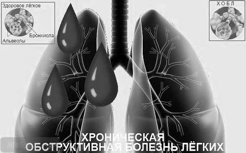 Хронічне обструктивне захворювання легень: лікування задишка