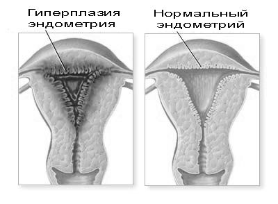 гіперплазія