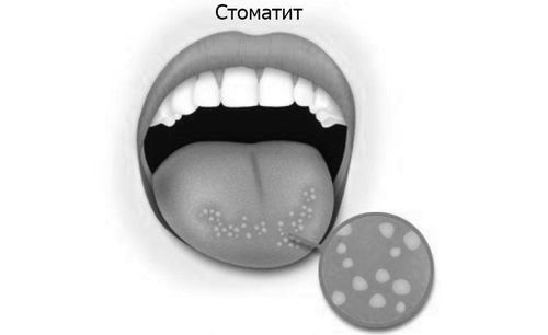 Як відрізнити ангіну від стоматиту за зовнішніми ознаками ангіну