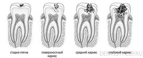 карієс