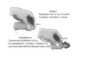 як лікувати простий баланопостит