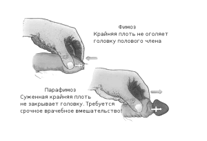 як лікувати простий баланопостит