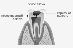 карієсу