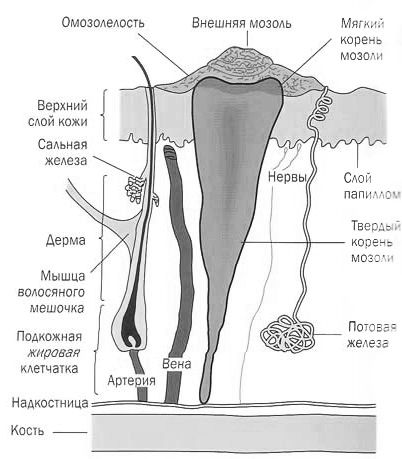 Мозоль на пальці ноги зі стрижнем: фото, причини появи, рецепти народної медицини ноги