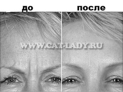 Парафінотерапія, показання та протипоказання парафінотерапія