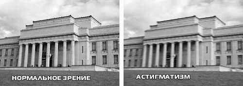Простий і складний міопічний астигматизм обох очей як лікувати миопический астигматизм