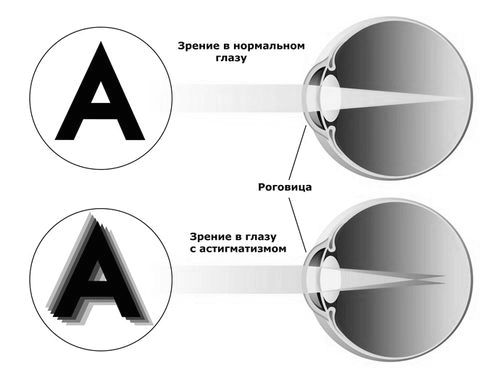 Простий і складний міопічний астигматизм обох очей простий