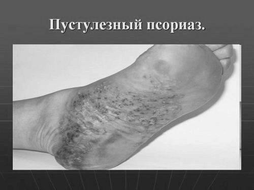 Пустульозний псоріаз: фото, опис хвороби, види, вогнища ураження псоріаз
