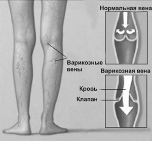 Варикоз глибоких вен нижніх кінцівок: лікування і симптоми варикоз