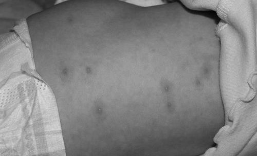 Вітрянка у дітей до року: симптоми, способи зараження дітей