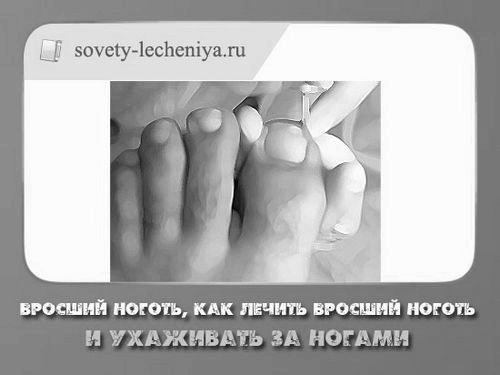 Врослий ніготь, як лікувати врослий ніготь і доглядати за ногами врослий