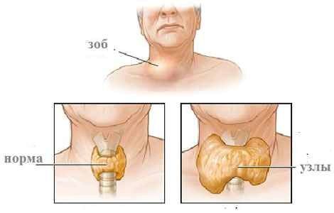 як лікувати багатовузловий зоб