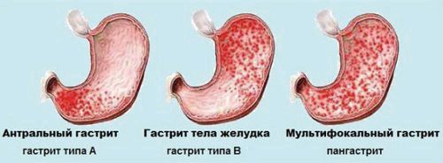 Поверхневий антральний гастрит: симптоми і лікування медикаментами... лікування