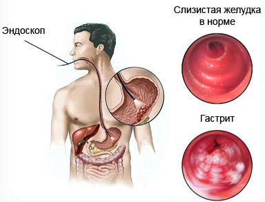 Поверхневий антральний гастрит: симптоми і лікування медикаментами... симптоми