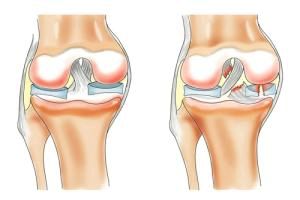 чи можна вилікувати меніск без операції