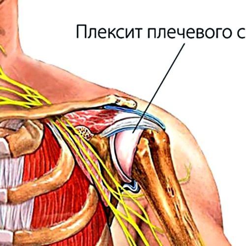 як лікувати розтягнення плеча