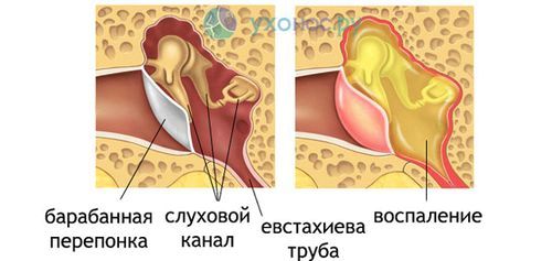 Грибок у вухах (отомікоз): симптоми і лікування лікувати грибковий отит