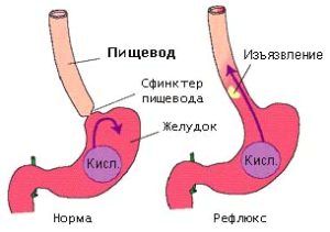 Печія після їжі: причини виникнення, препарати для лікування в домашніх умовах як лікувати печію шлунка