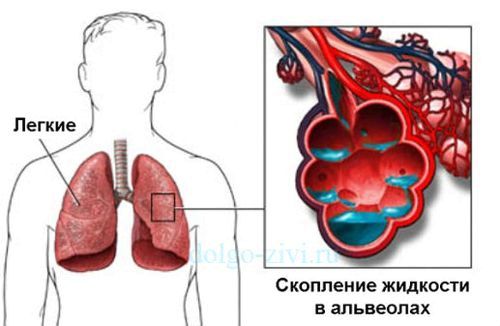 як лікувати серцеву астму народними засобами