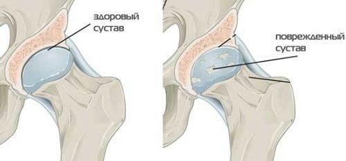 як лікувати артроз 2 ступеня тазостегнового суглоба