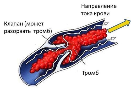 як лікувати варикоз кишечника