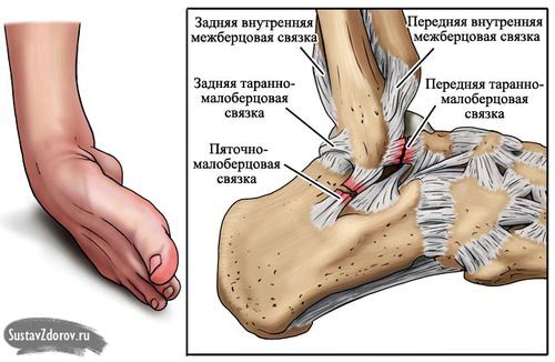 як лікувати розтягнення зв'язок щиколотки