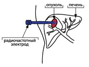 як лікувати рак черевної порожнини