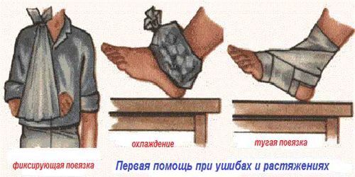 як лікувати розтягнення народними засобами