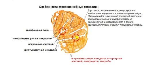 як лікувати хронічні гланди