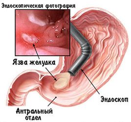 Виразкова хвороба як лікувати виразку шлунка і дванадцятипалої кишки