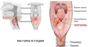 як лікувати рак гортані 4 стадії