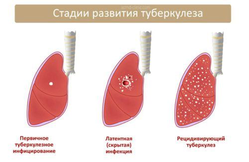 як лікувати хворобу туберкульоз