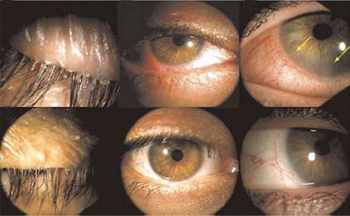 демодекоз очей офтальмодемодекоза очної краплі демодекс століття повіки вій віях на симптоми лікування