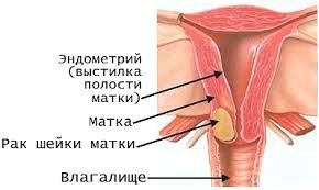 якщо не лікувати рак шийки матки