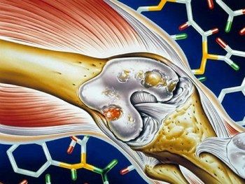 Як лікувати ревматоїдний артрит: ознаки, симптоми і лікування як лікувати ГРВІ при ревматоїдному артриті