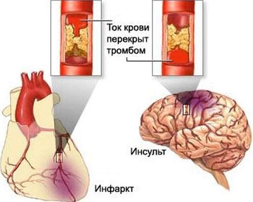 Міні інсульт симптоми - лікування серця як лікувати міні інсульт