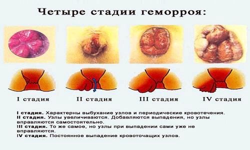 лікувати геморой реліф