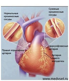 Хвороби серця і судин при цукровому діабеті: симптоми і ознаки лікувати судини при цукровому діабеті