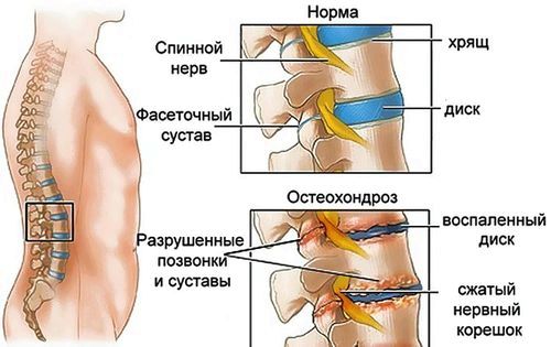 як лікувати остеохондроз домашніх умовах