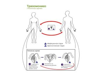 складно лікувати трихомоніаз