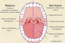 Препарати для лікування фарингіту у дорослих лікувати фарингіт дорослих