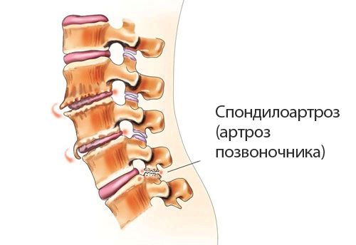 як вилікувати артроз хребта